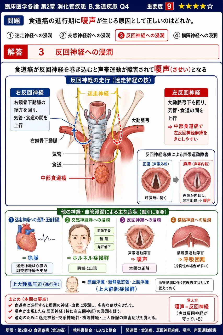 食道癌の進行期に嗄声が生じる原因として正しいのはどれか。 解説図