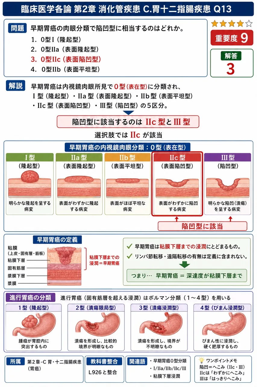 早期胃癌の肉眼分類で陥凹型に相当するのはどれか。 解説図