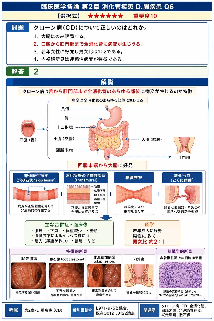 クローン病(CD)について正しいのはどれか。 解説図