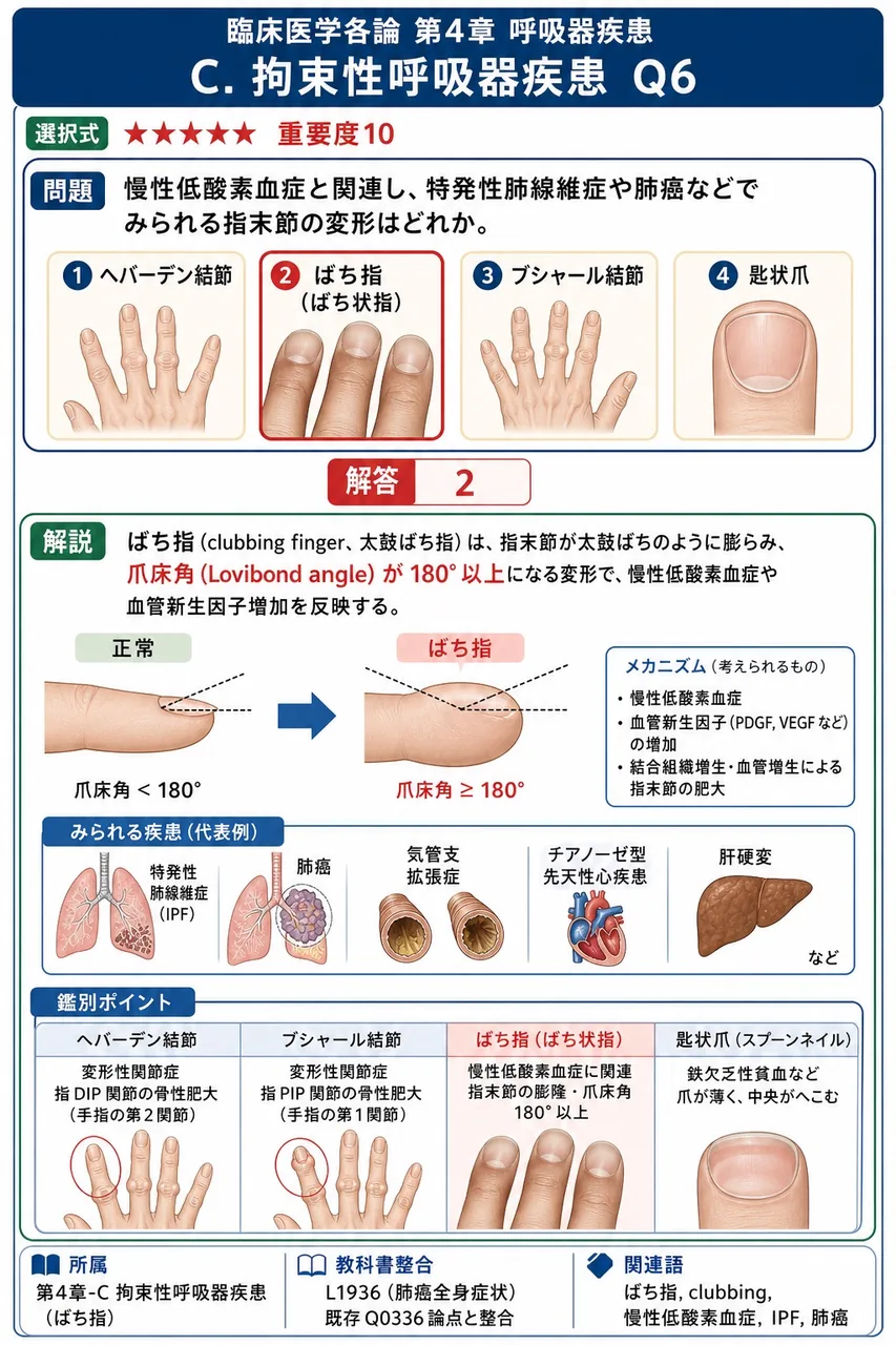 慢性低酸素血症と関連し、特発性肺線維症や肺癌などでみられる指末節の変形はどれか。 解説図