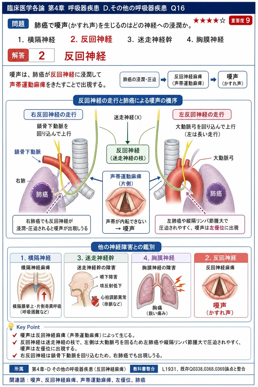 肺癌で嗄声(かすれ声)を生じるのはどの神経への浸潤か。 解説図