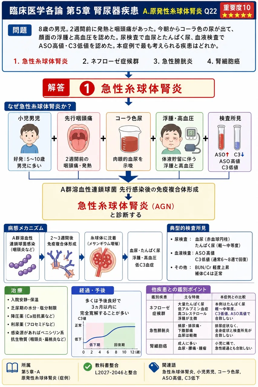 「8歳の男児。2週間前に発熱と咽頭痛があった。今朝からコーラ色の尿が出て、顔面の浮腫と高血圧を認めた。尿検査で血尿とたんぱく尿、血液検査でASO高値・C3低値を認めた。」本症例で最も考えられる疾患はどれか。 解説図