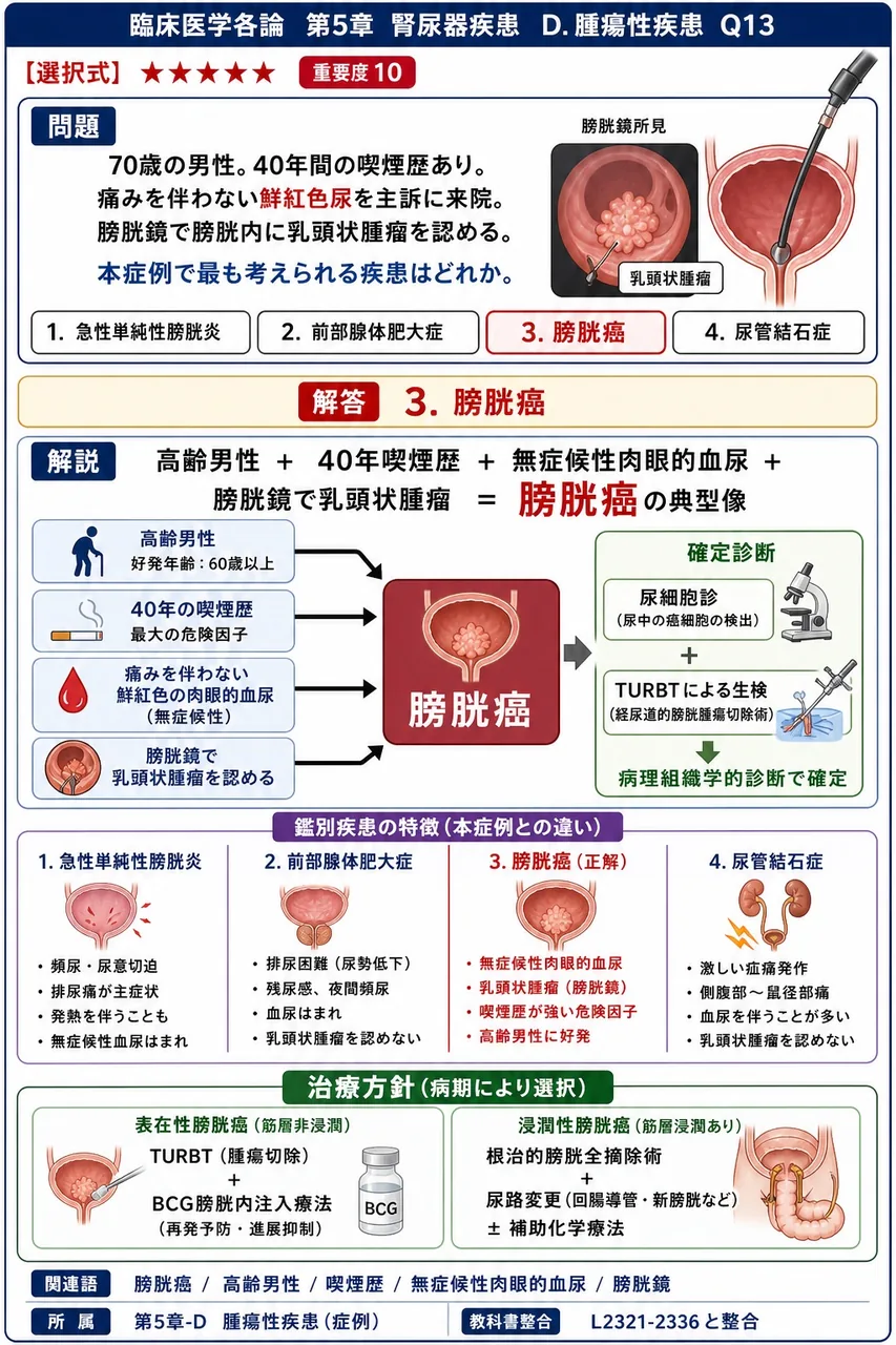 「70歳の男性。40年間の喫煙歴あり。痛みを伴わない鮮紅色尿を主訴に来院。膀胱鏡で膀胱内に乳頭状腫瘤を認める。」本症例で最も考えられる疾患はどれか。 解説図