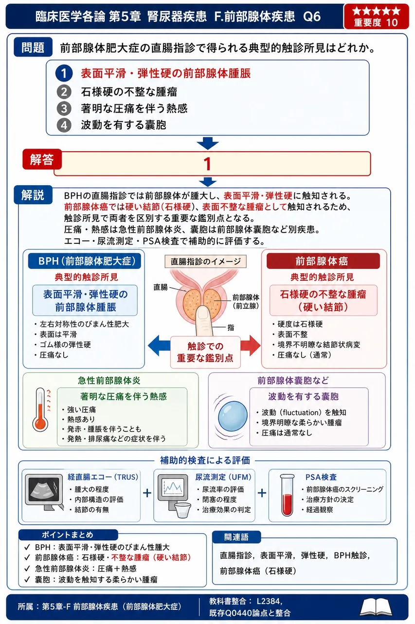 前立腺肥大症の直腸指診で得られる典型的触診所見はどれか。 解説図