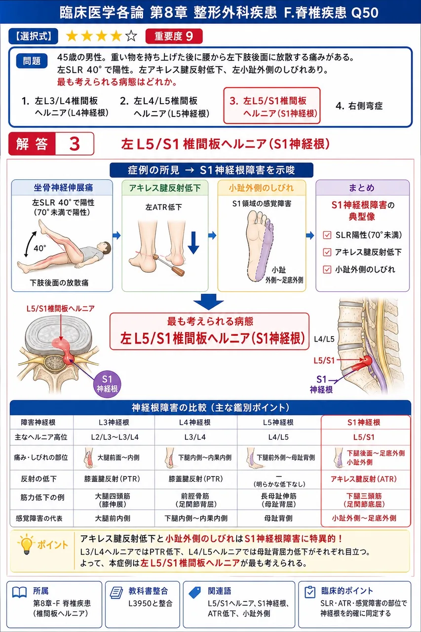 「45歳の男性。重い物を持ち上げた後に腰から左下肢後面に放散する痛みがある。左SLR 40°で陽性。左アキレス腱反射低下、左小趾外側のしびれあり。」最も考えられる病態はどれか。 解説図