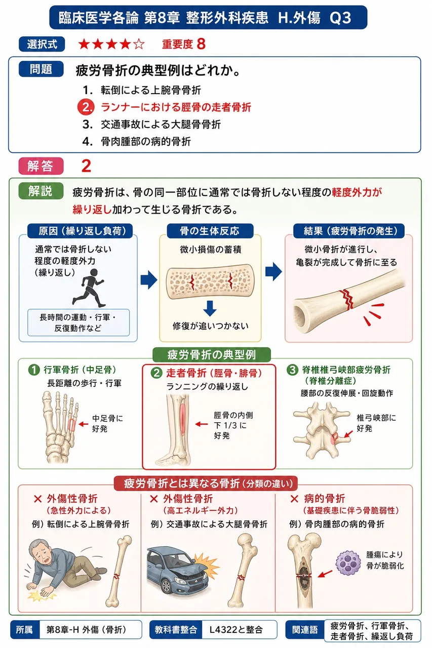 疲労骨折の典型例はどれか。 解説図