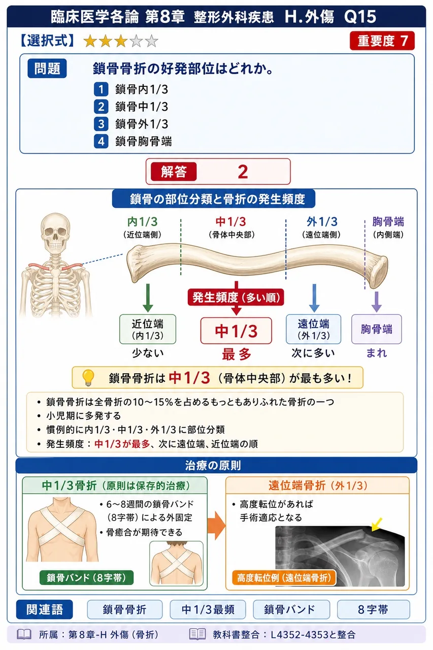 鎖骨骨折の好発部位はどれか。 解説図