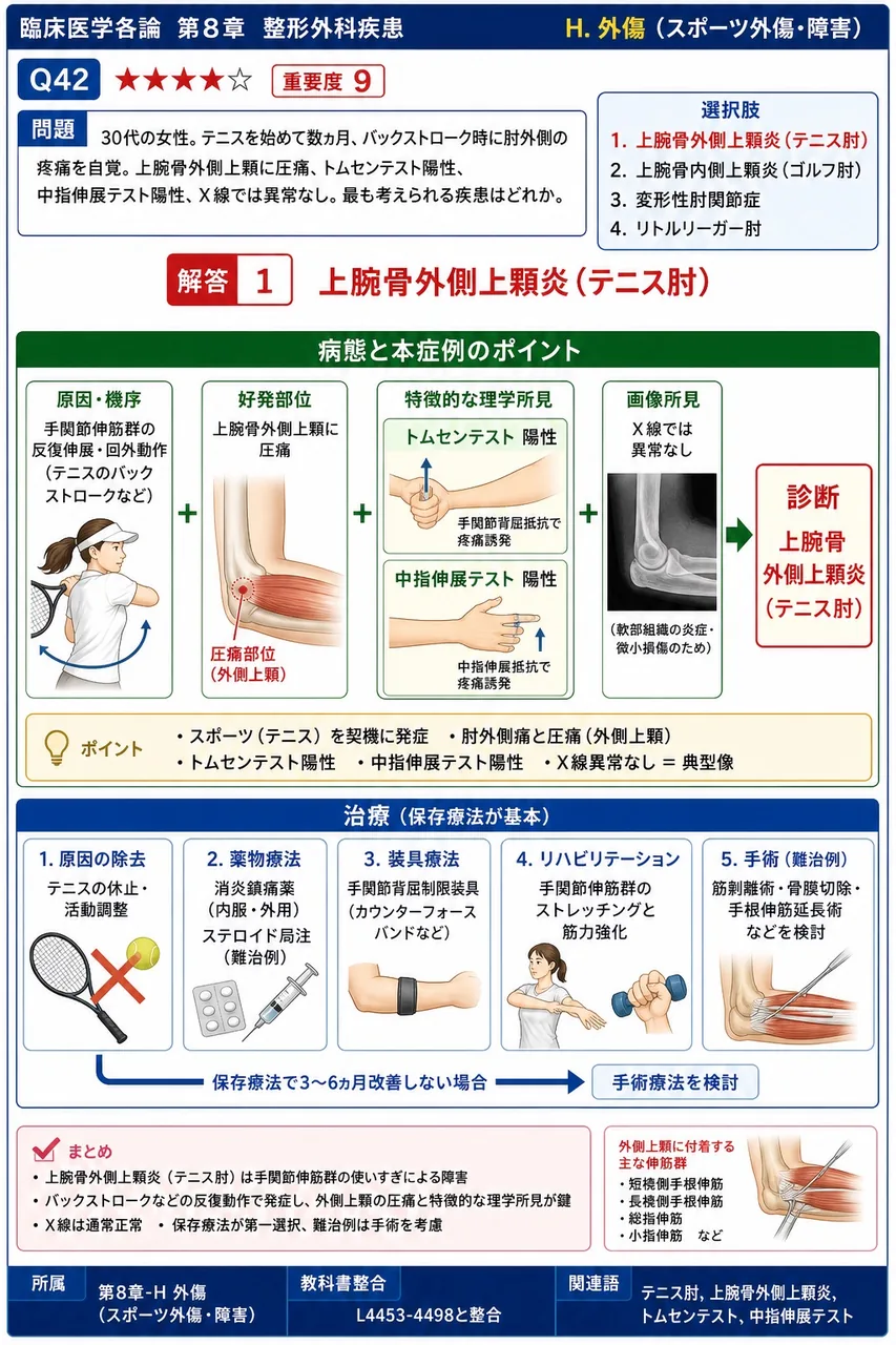 「30代の女性。テニスを始めて数ヵ月、バックストローク時に肘外側の疼痛を自覚。上腕骨外側上顆に圧痛、トムセンテスト陽性、中指伸展テスト陽性、X線では異常なし。」最も考えられる疾患はどれか。 解説図