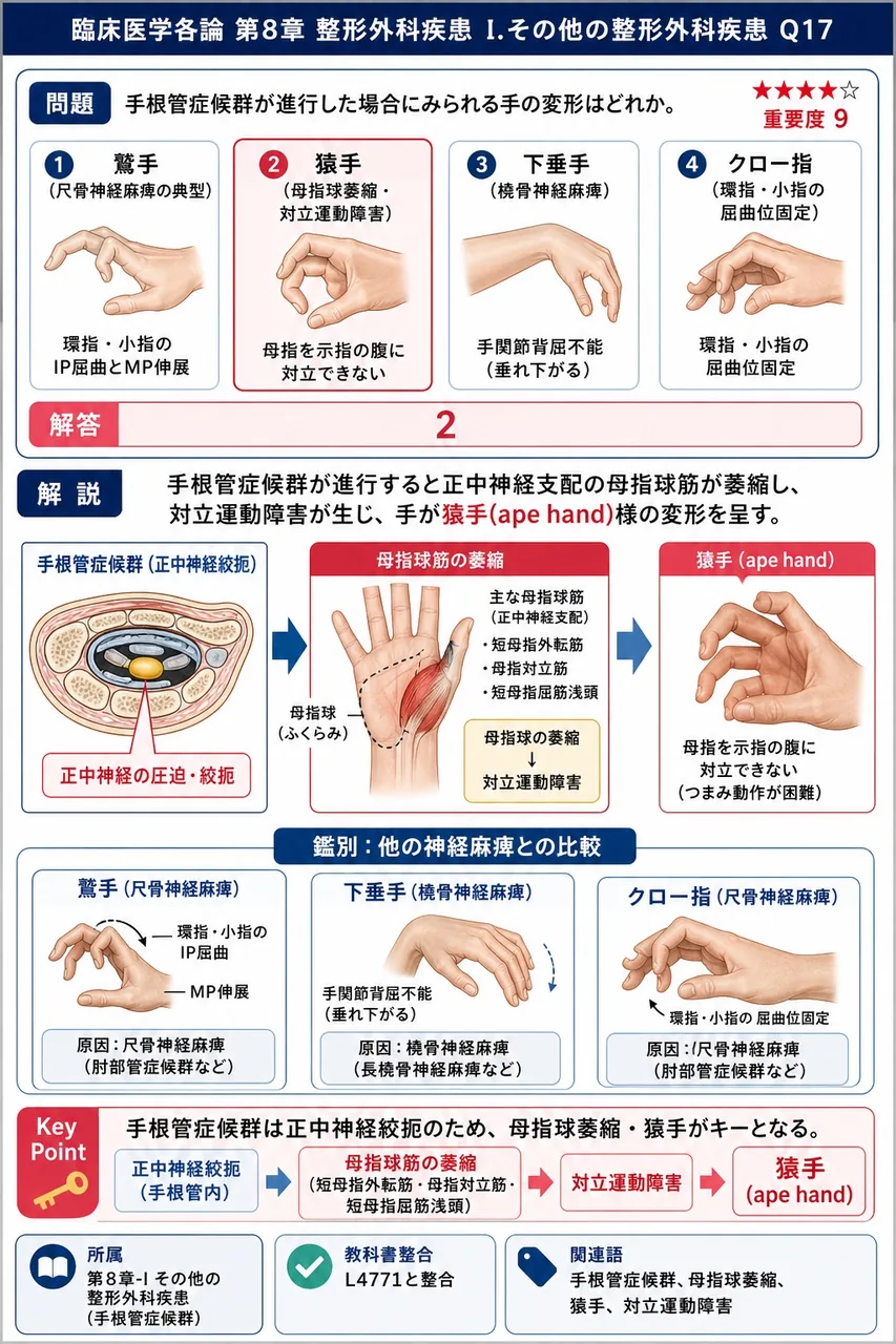 手根管症候群が進行した場合にみられる手の変形はどれか。 解説図