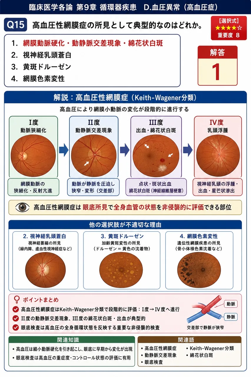 高血圧性網膜症の所見として典型的なのはどれか。 解説図