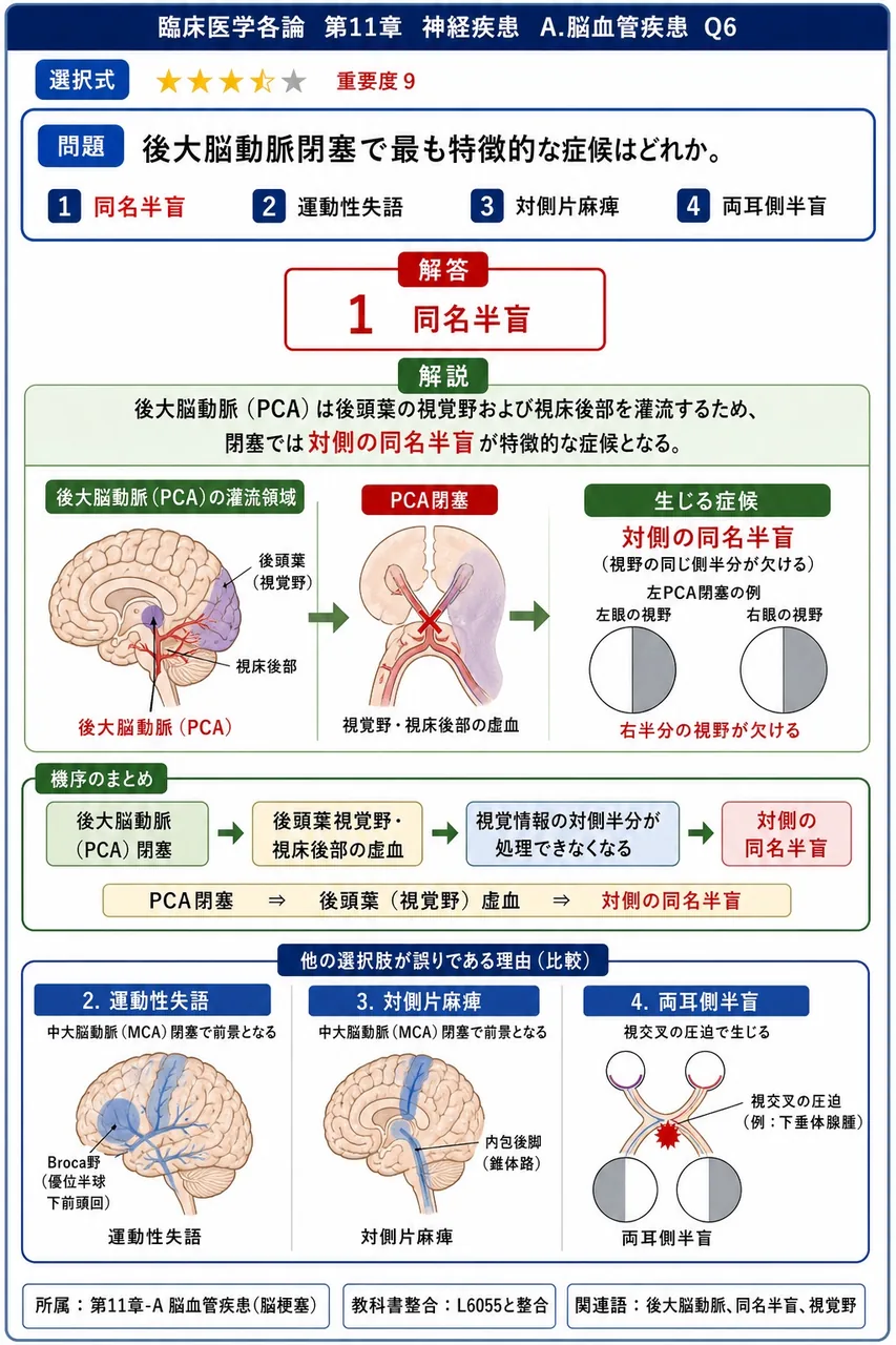 後大脳動脈閉塞で最も特徴的な症候はどれか。 解説図