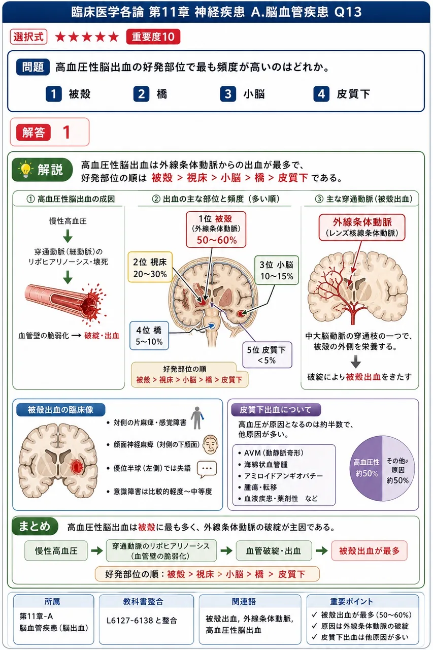 高血圧性脳出血の好発部位で最も頻度が高いのはどれか。 解説図