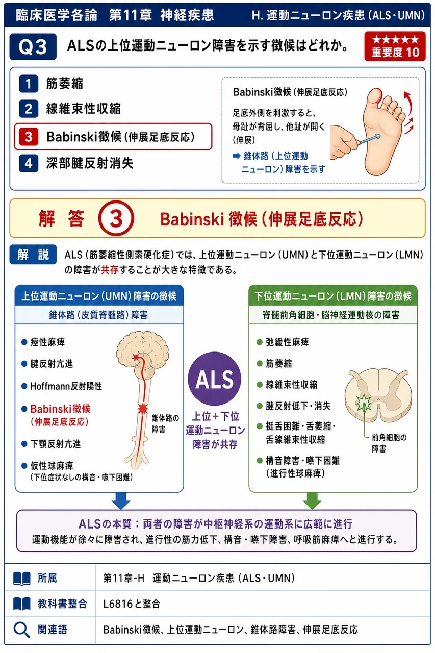 ALSの上位運動ニューロン障害を示す徴候はどれか。 解説図