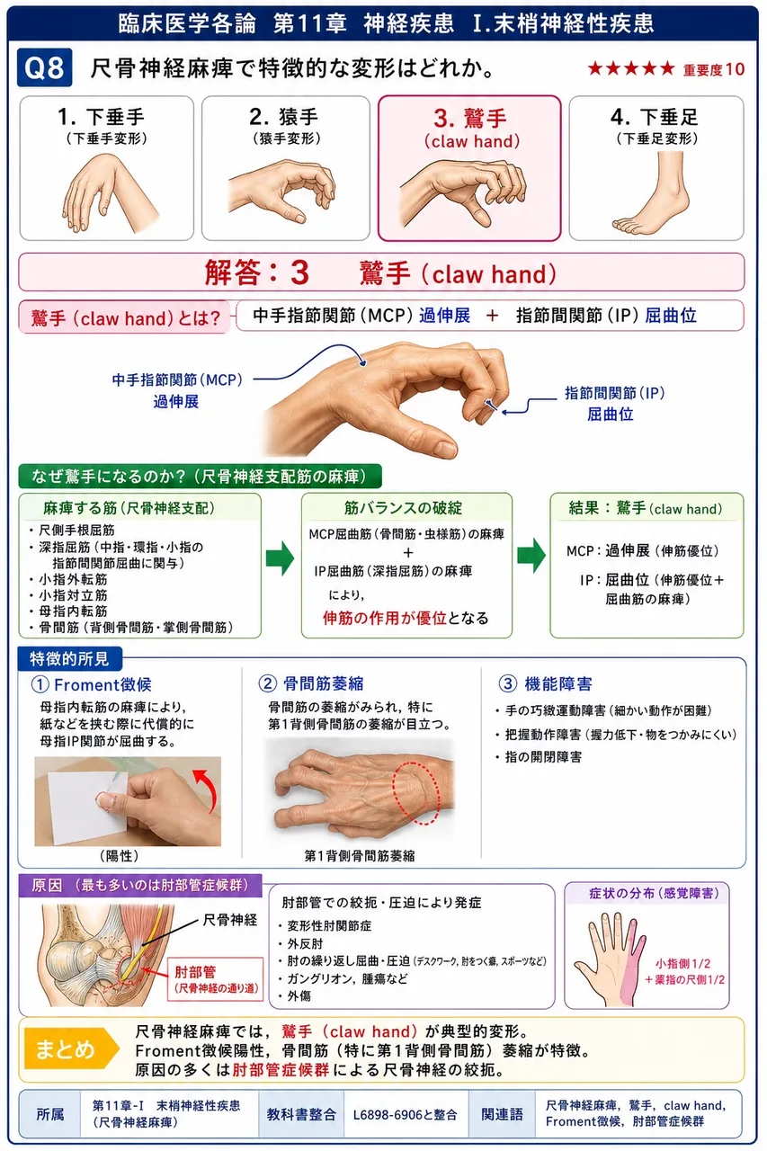 尺骨神経麻痺で特徴的な変形はどれか。 解説図