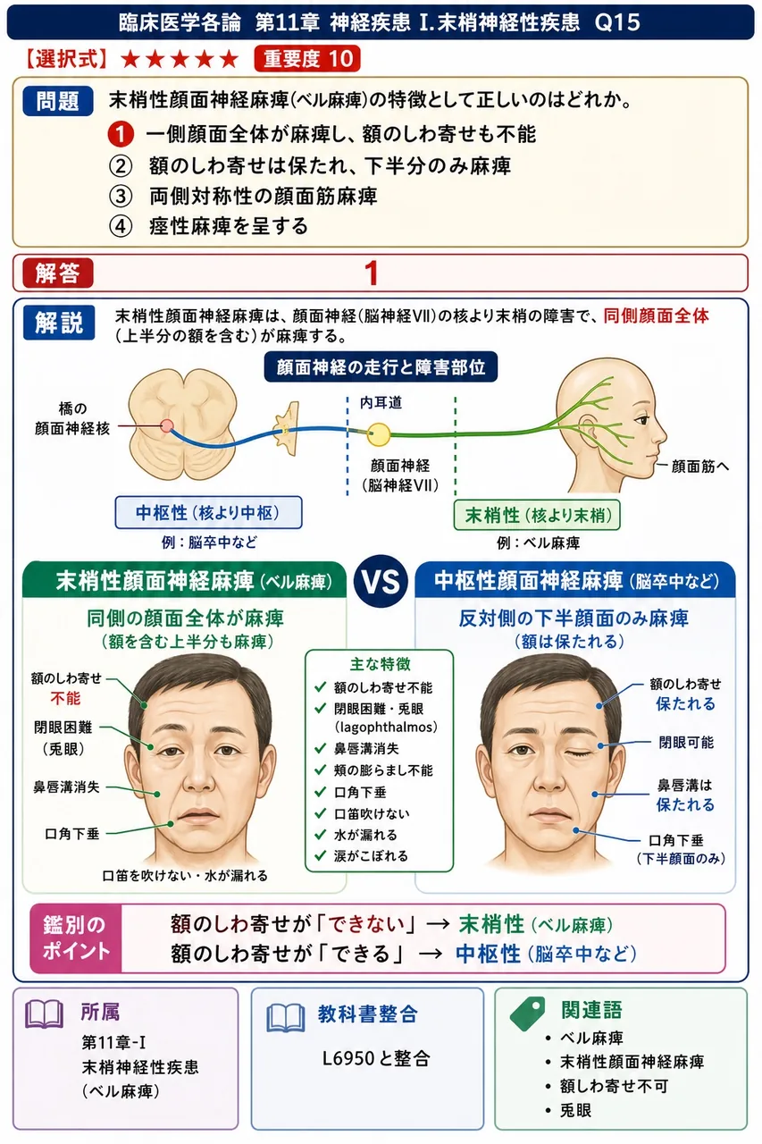 末梢性顔面神経麻痺(ベル麻痺)の特徴として正しいのはどれか。 解説図