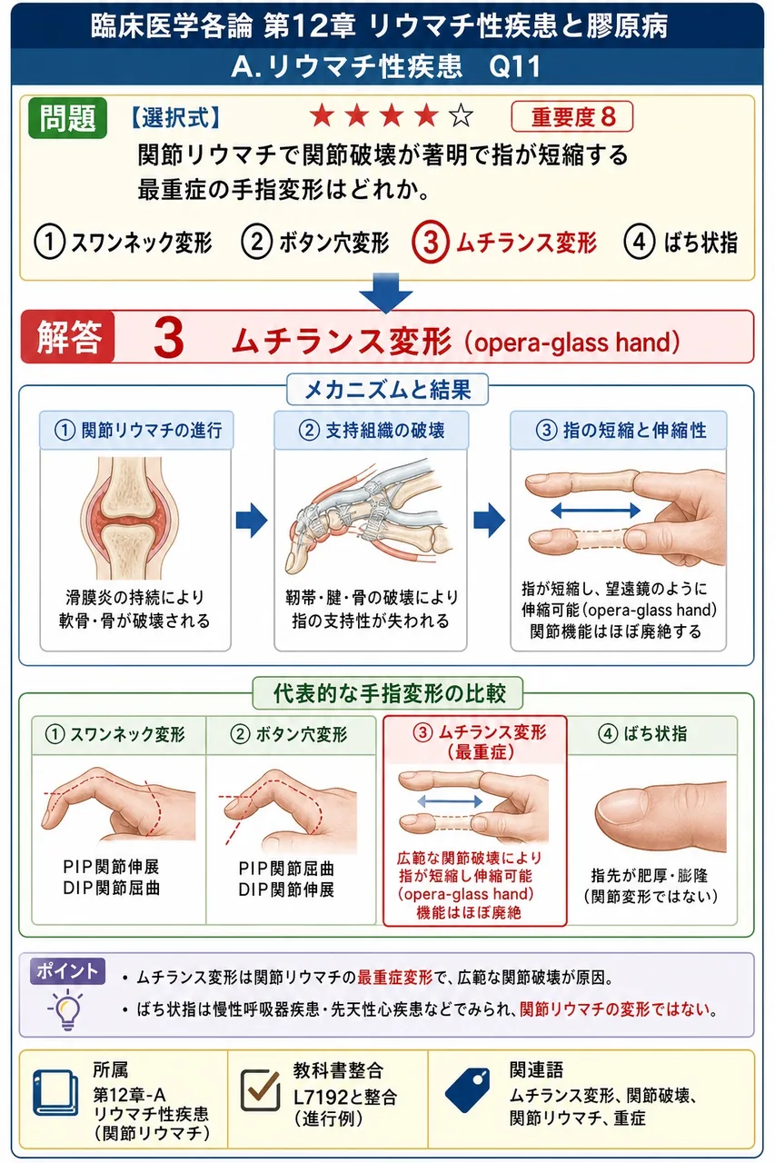 関節リウマチで関節破壊が著明で指が短縮する最重症の手指変形はどれか。 解説図