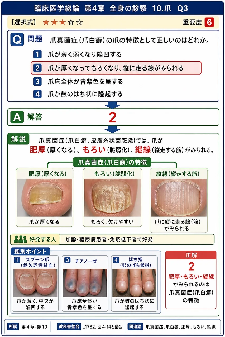 爪真菌症(爪白癬)の爪の特徴として正しいのはどれか。 解説図