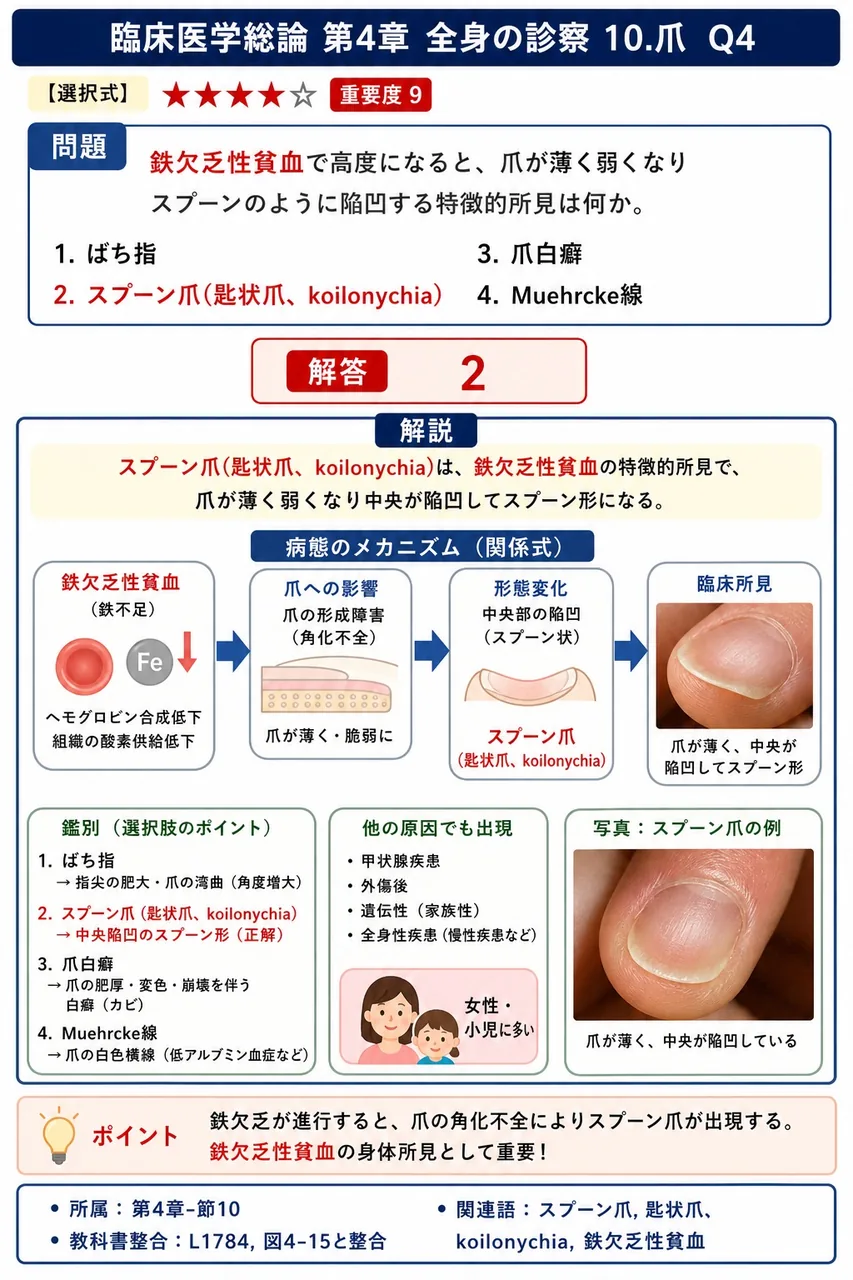**鉄欠乏性貧血**で高度になると、爪が薄く弱くなりスプーンのように陥凹する特徴的所見を何というか。 解説図