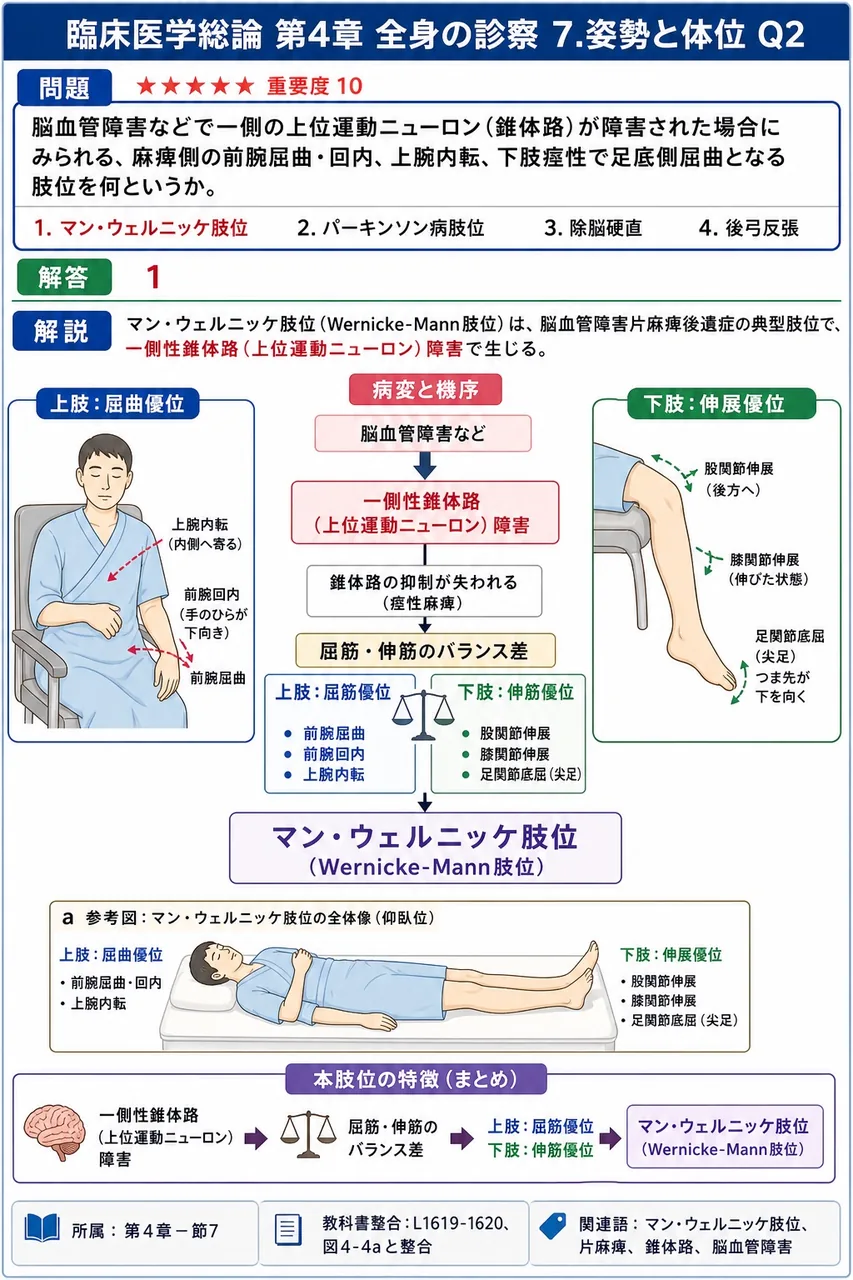 脳血管障害などで一側の上位運動ニューロン(錐体路)が障害された場合にみられる、麻痺側の前腕屈曲・回内、上腕内転、下肢痙性で足底側屈曲となる肢位を何というか。 解説図