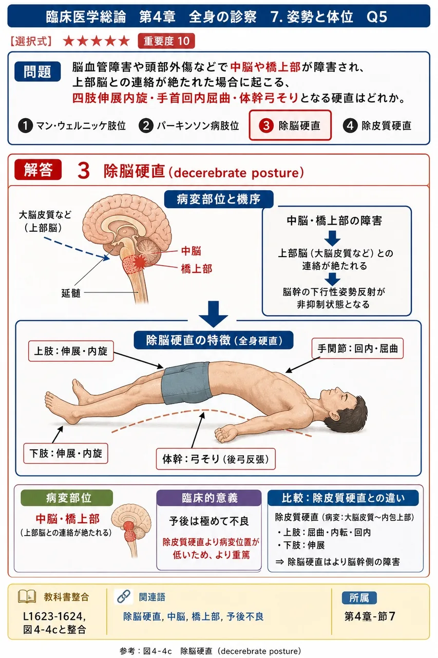 脳血管障害や頭部外傷などで**中脳や橋上部**が障害され、上部脳との連絡が絶たれた場合に起こる、四肢伸展内旋・手首回内屈曲・体幹弓そりとなる硬直はどれか。 解説図