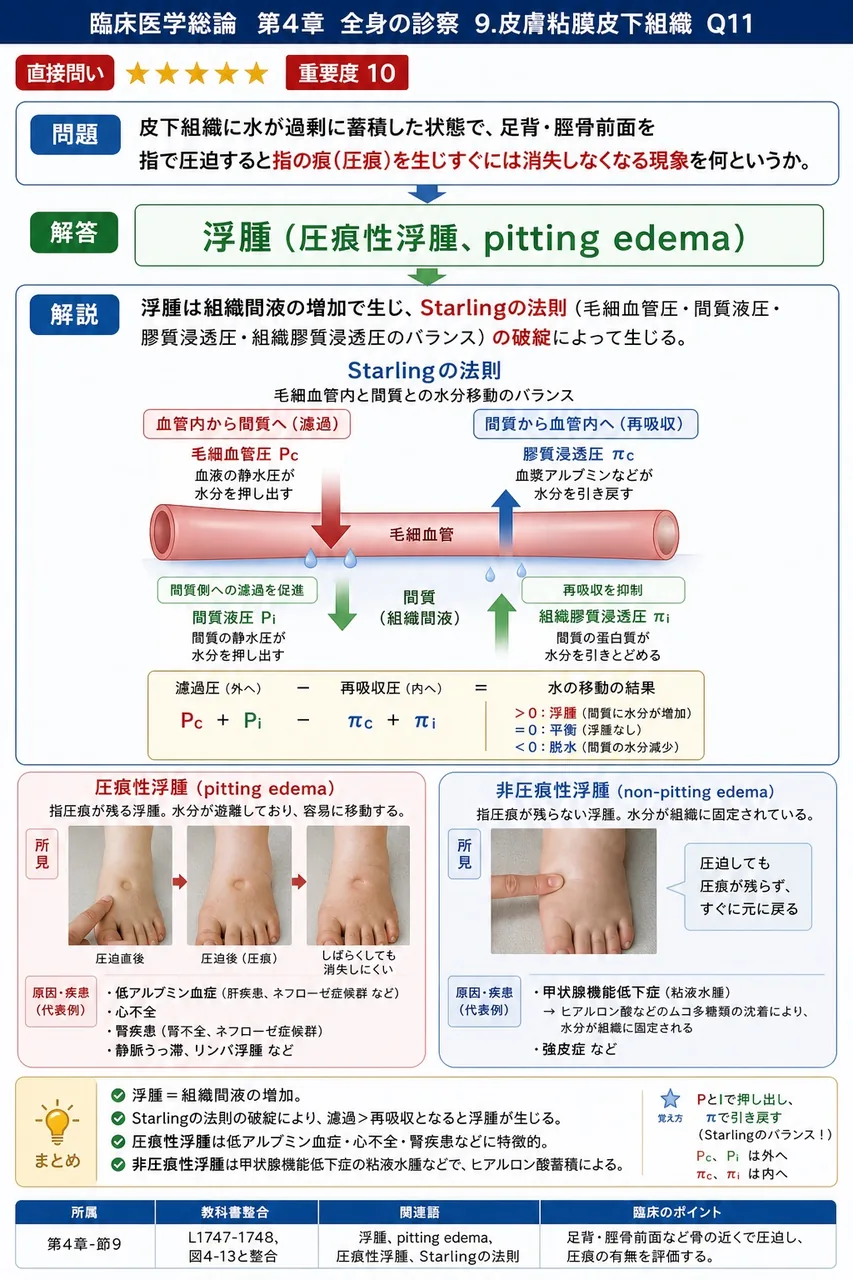 皮下組織に水が過剰に蓄積した状態で、足背・脛骨前面を指で圧迫すると指の痕(圧痕)を生じすぐには消失しなくなる現象を何というか。 解説図