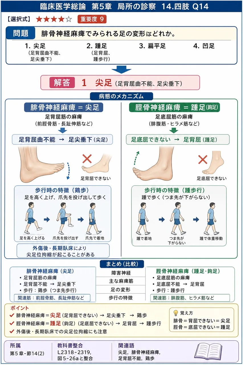 腓骨神経麻痺でみられる足の変形はどれか。 解説図