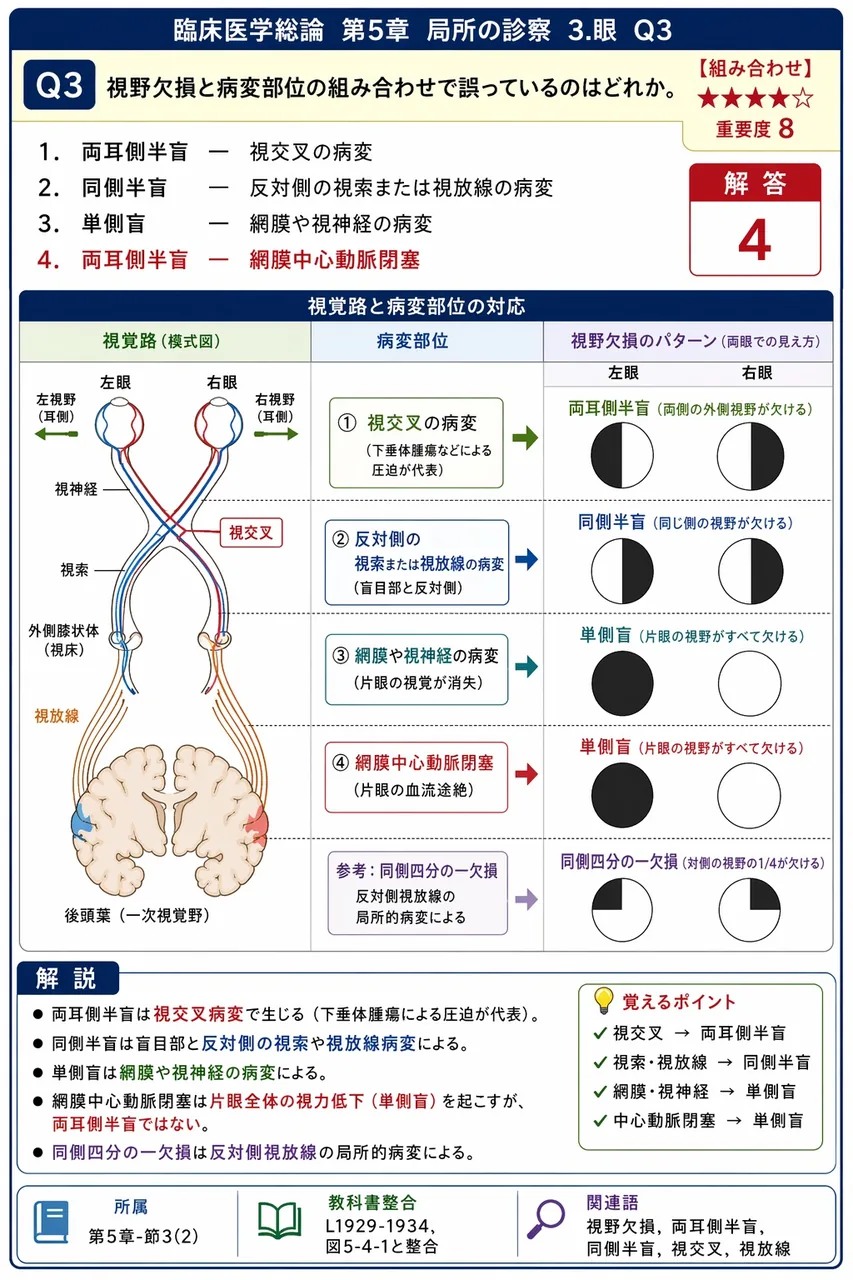 視野欠損と病変部位の組み合わせで誤っているのはどれか。 解説図