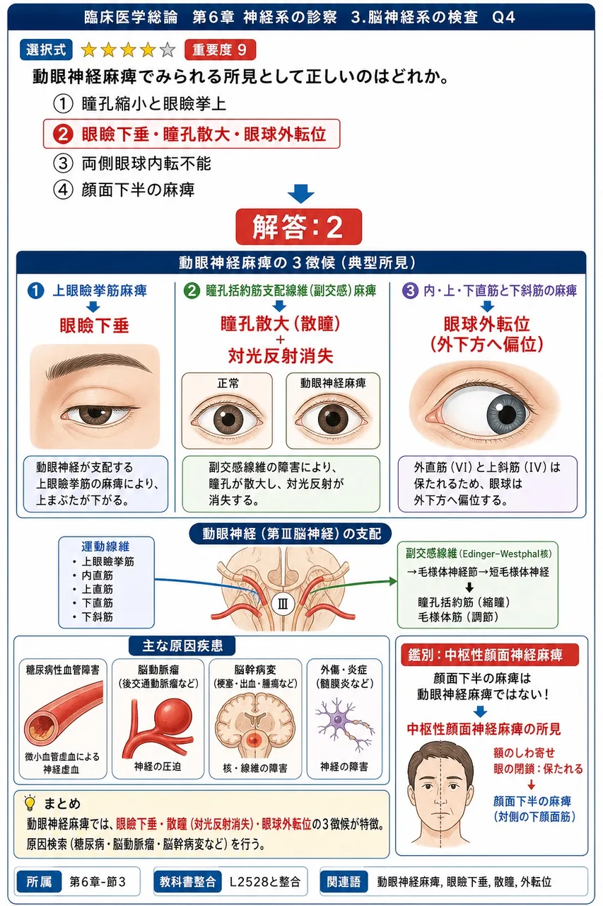 動眼神経麻痺でみられる所見として正しいのはどれか。 解説図