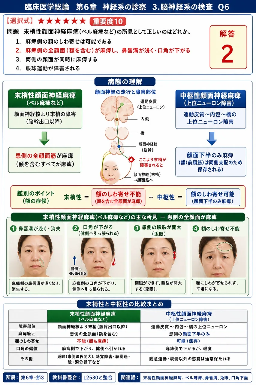 末梢性顔面神経麻痺(ベル麻痺など)の所見として正しいのはどれか。 解説図