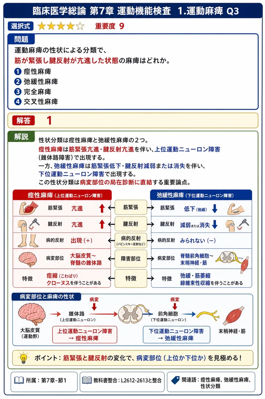 運動麻痺の性状による分類で、筋が緊張し腱反射が亢進した状態の麻痺はどれか。 解説図