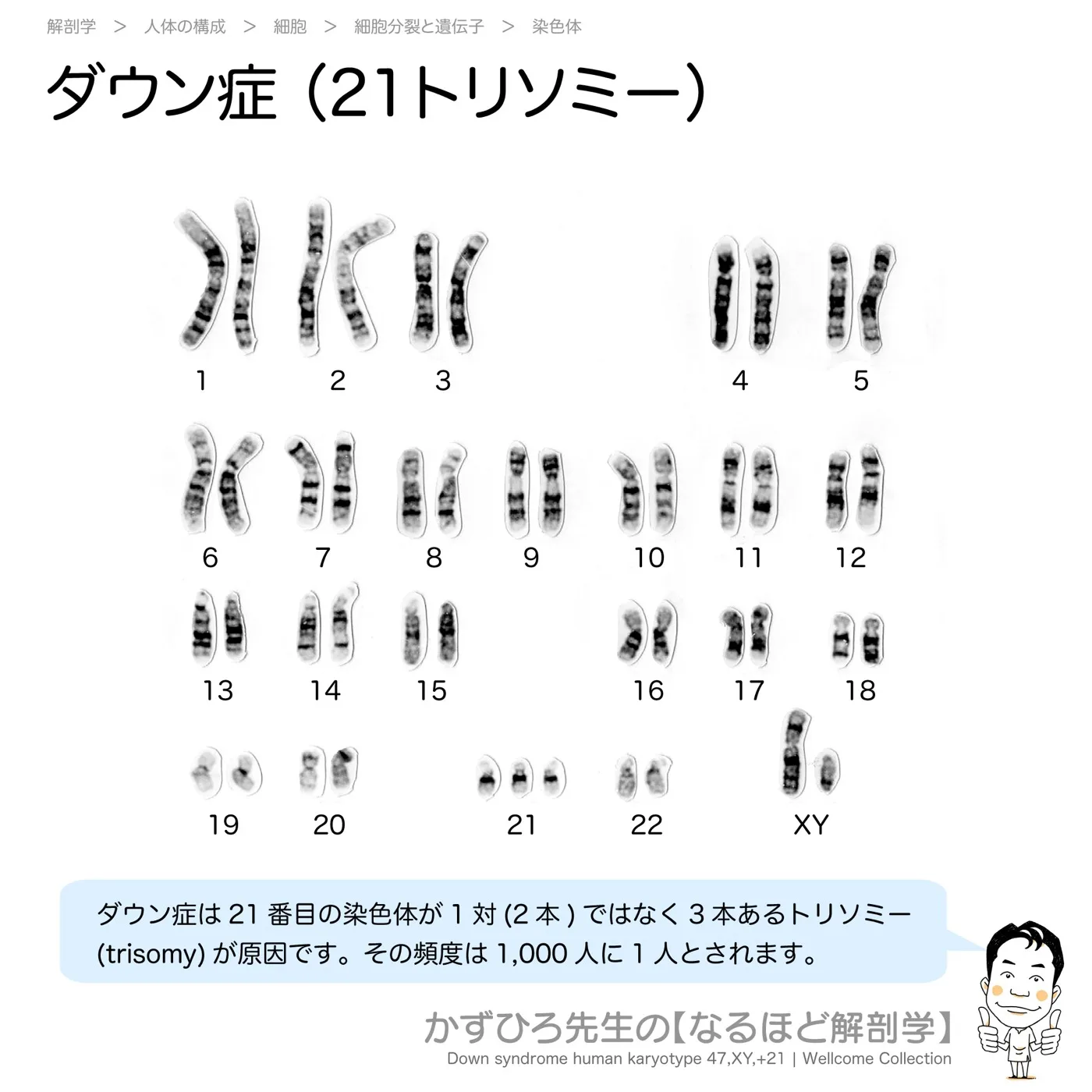 ダウン症（21トリソミー）