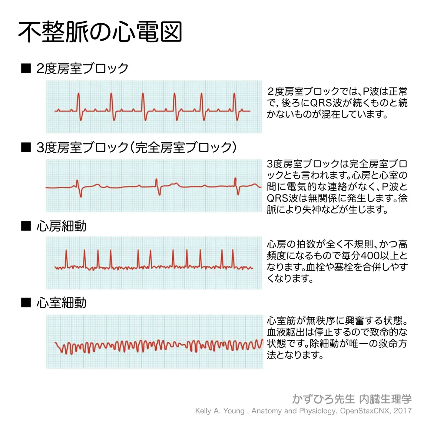不整脈の心電