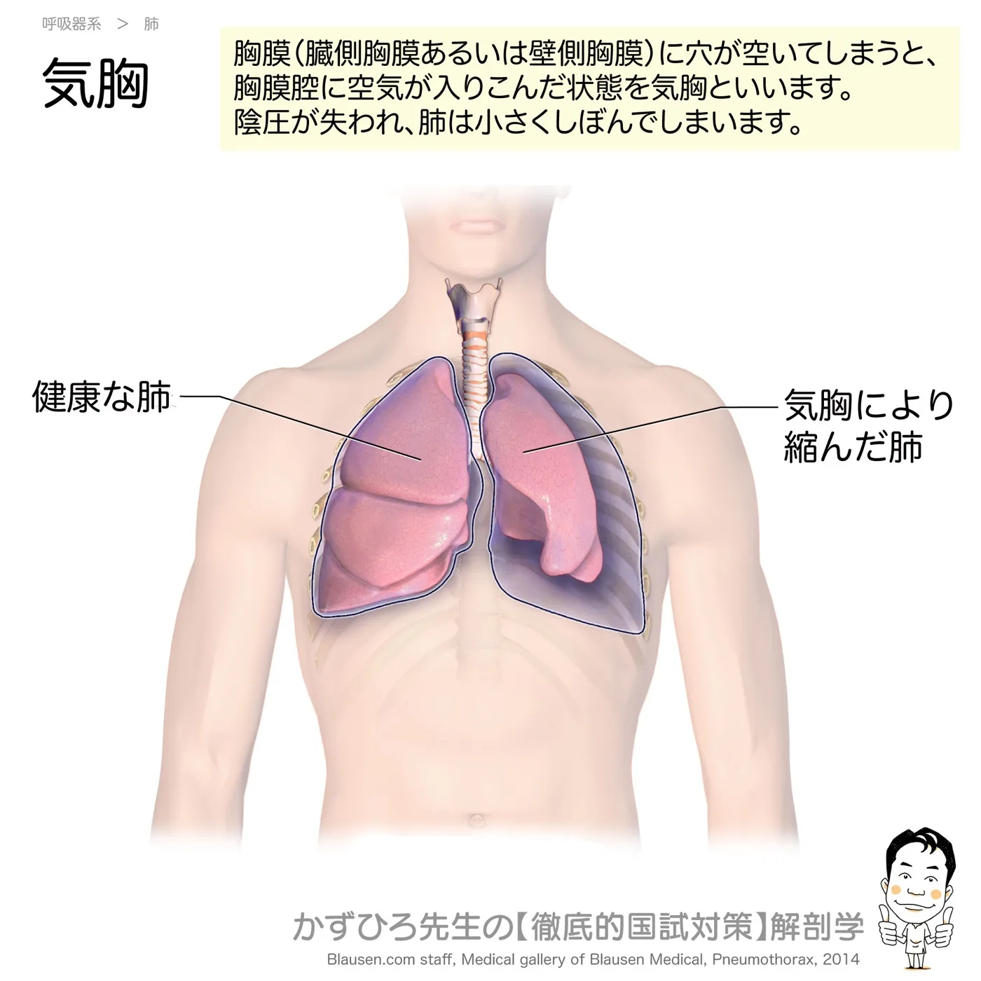 気胸