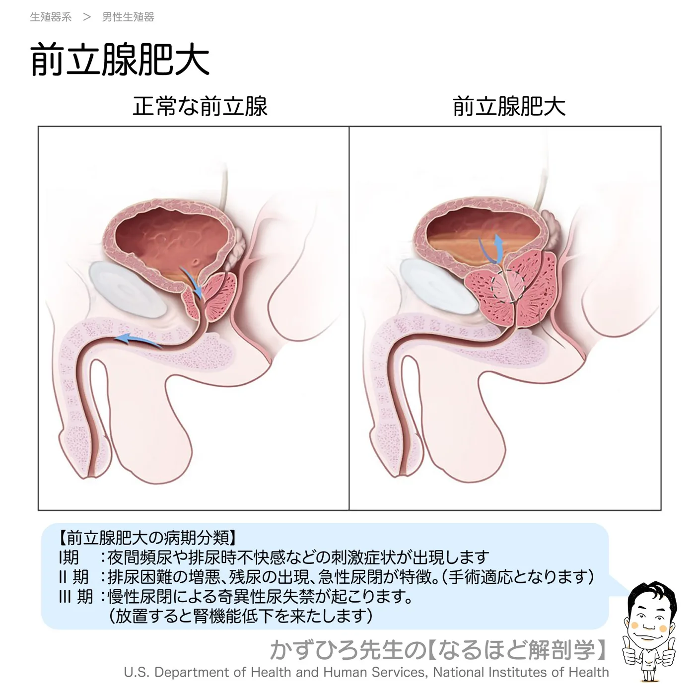 生殖器系-前立腺肥大