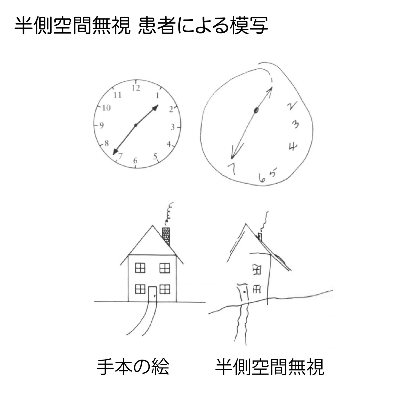 半側空間無視