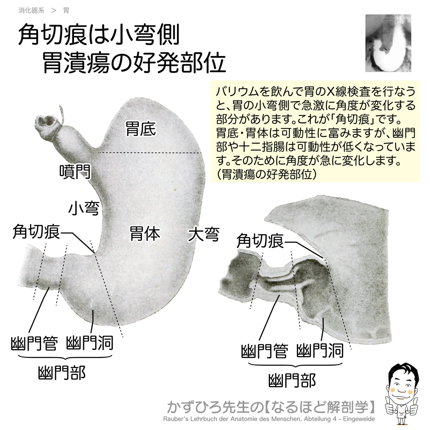 角切痕は小弯側-胃潰瘍の好発部位