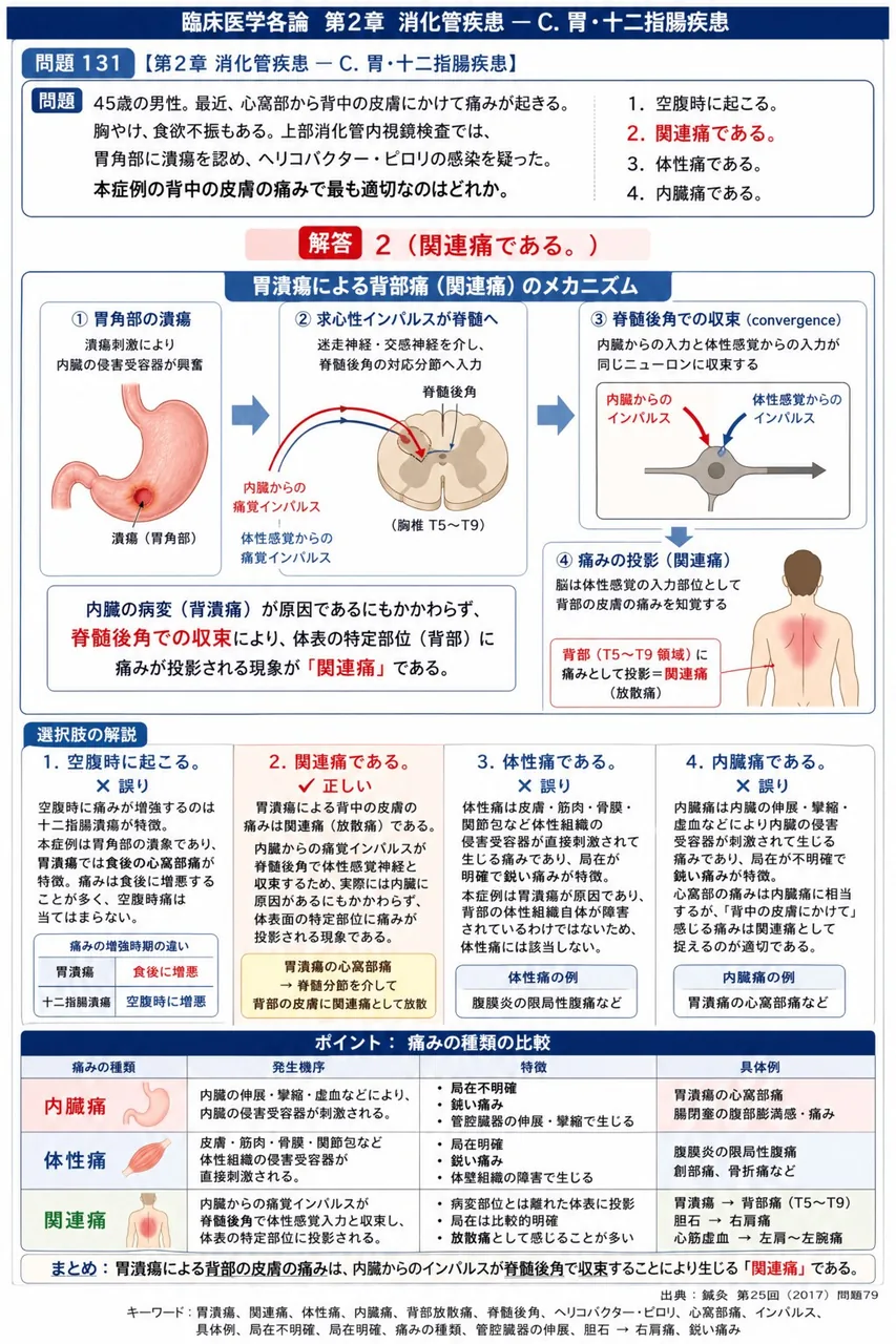 鍼灸 第25回(2017) 問題79｜「45歳の男性。最近、心窩部から背中の皮膚にかけて痛みが起きる。胸やけ、食欲不振もある｡上部消化管内視鏡検査では、胃角部に潰瘍を認め、ヘリコバクター・ピロリの感染を疑った。」本症例の背中の皮膚の痛みで最も適切なのはどれか。 解説図
