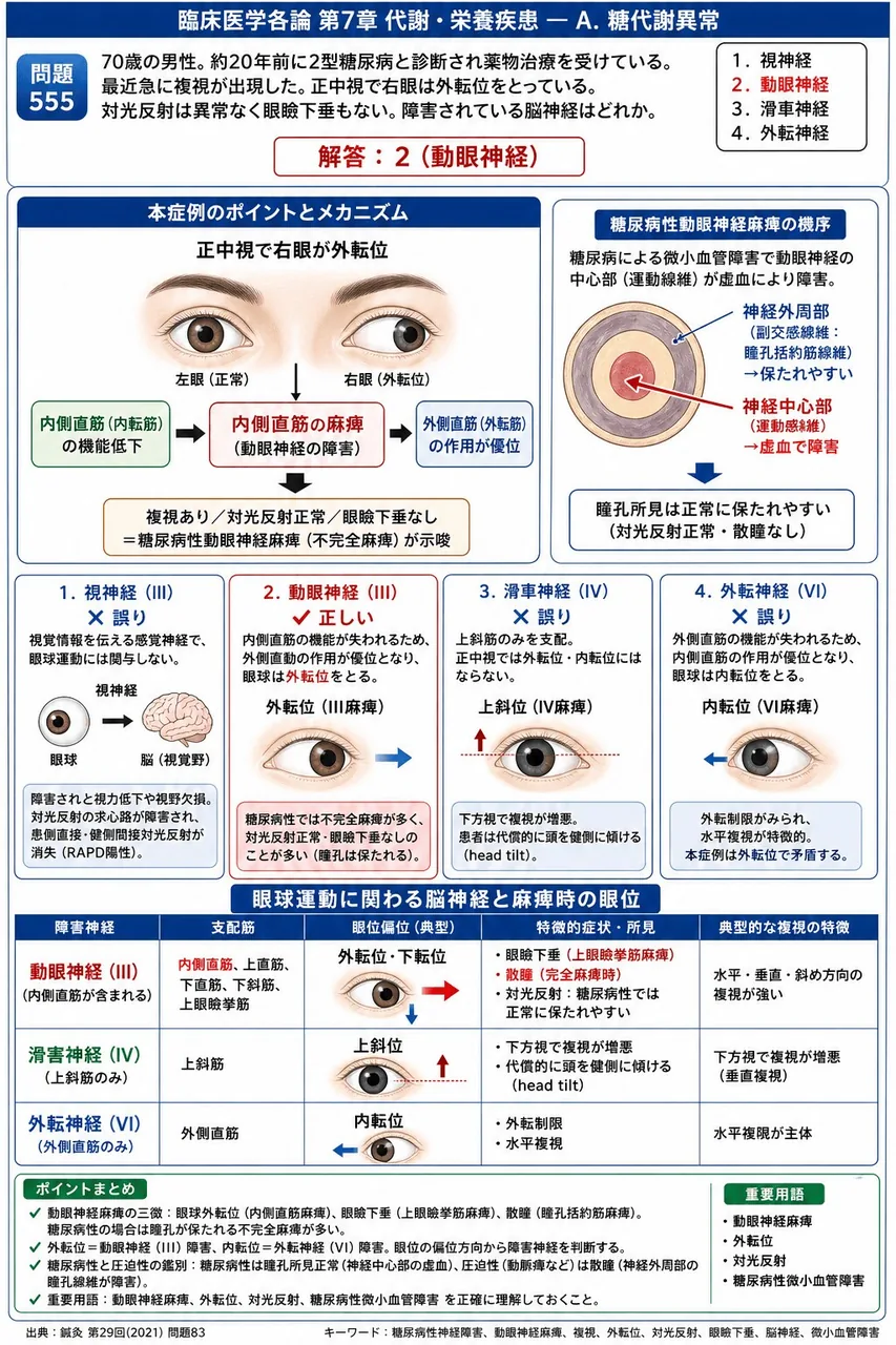 鍼灸 第29回(2021) 問題83｜「70歳の男性。約20年前に2型糖尿病と診断され薬物治療を受けている。最近急に複視が出現した。正中視で右眼は外転位をとっている。対光反射は異常なく眼瞼下垂もない。」障害されている脳神経はどれか。 解説図