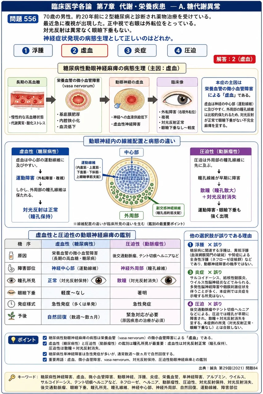 鍼灸 第29回(2021) 問題84｜「70歳の男性。約20年前に2型糖尿病と診断され薬物治療を受けている。最近急に複視が出現した。正中視で右眼は外転位をとっている。対光反射は異常なく眼瞼下垂もない。」神経症状発現の病態生理として正しいのはどれか。 解説図
