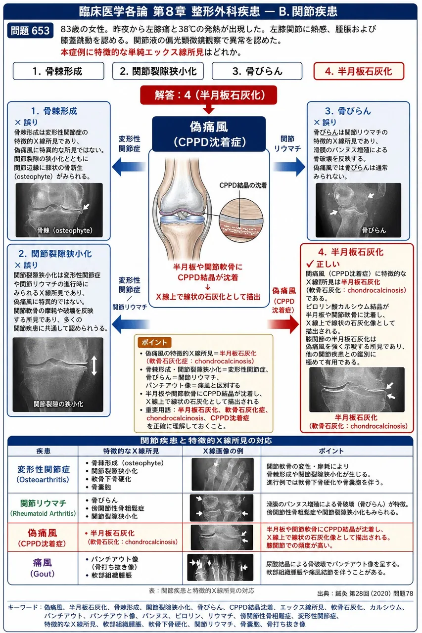 鍼灸 第28回(2020) 問題78｜「83歳の女性。昨夜から左膝痛と38℃の発熱が出現した。左膝関節に熱感、腫脹および膝蓋跳動を認める。関節液の偏光顕微鏡観察で異常を認めた。」本症例に特徴的な単純エックス線所見はどれか。 解説図