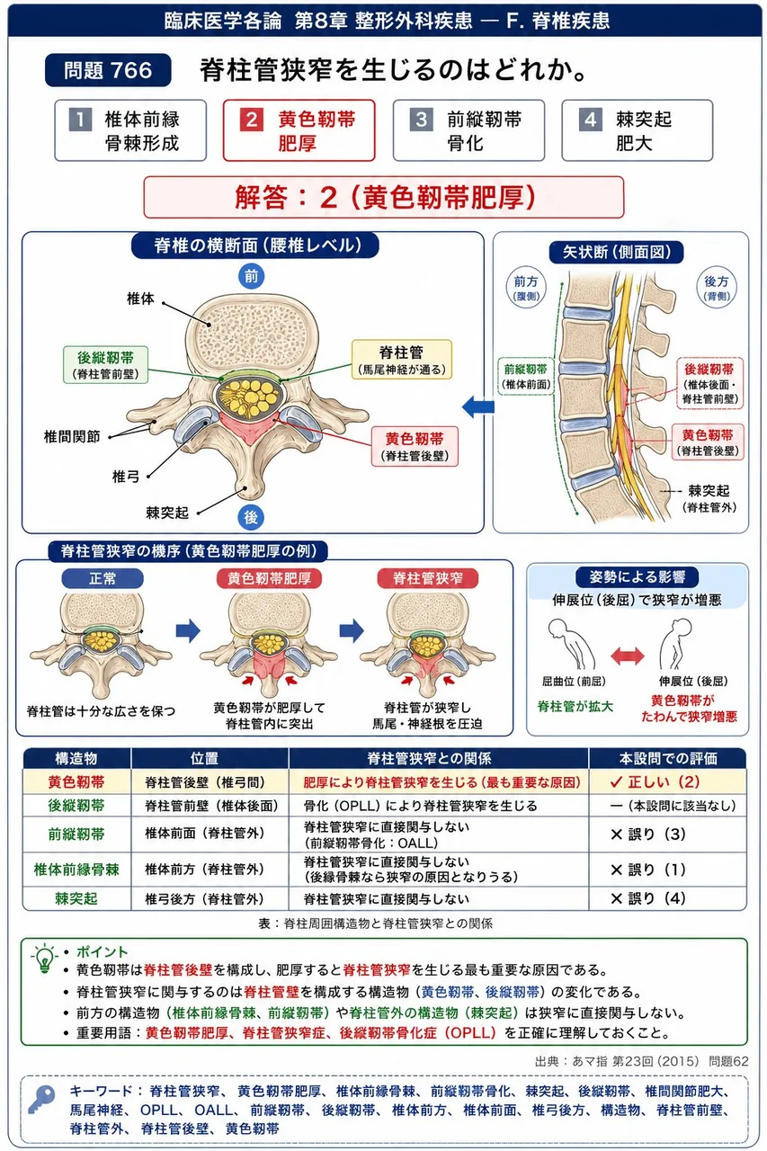 あマ指 第23回(2015) 問題62｜脊柱管狭窄を生じるのはどれか。 解説図