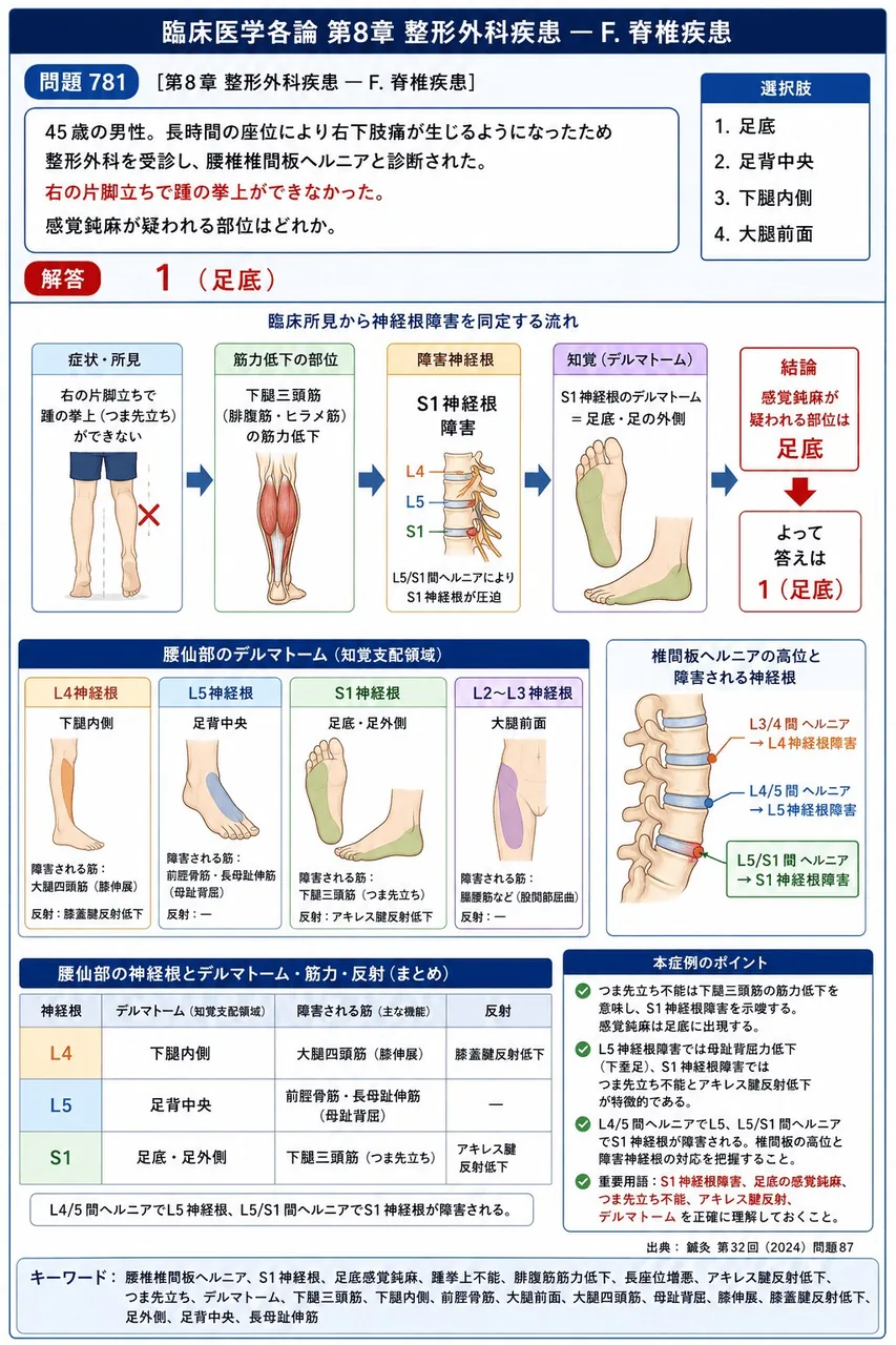 鍼灸 第32回(2024) 問題87｜次の文で示す症例について、問いに答えよ。「45歳の男性。長時間の座位により右下肢痛が生じるようになったため整形外科を受診し、腰椎椎間板ヘルニアと診断された。右の片脚立ちで踵の挙上ができなかった。」感覚鈍麻が疑われる部位はどれか。 解説図