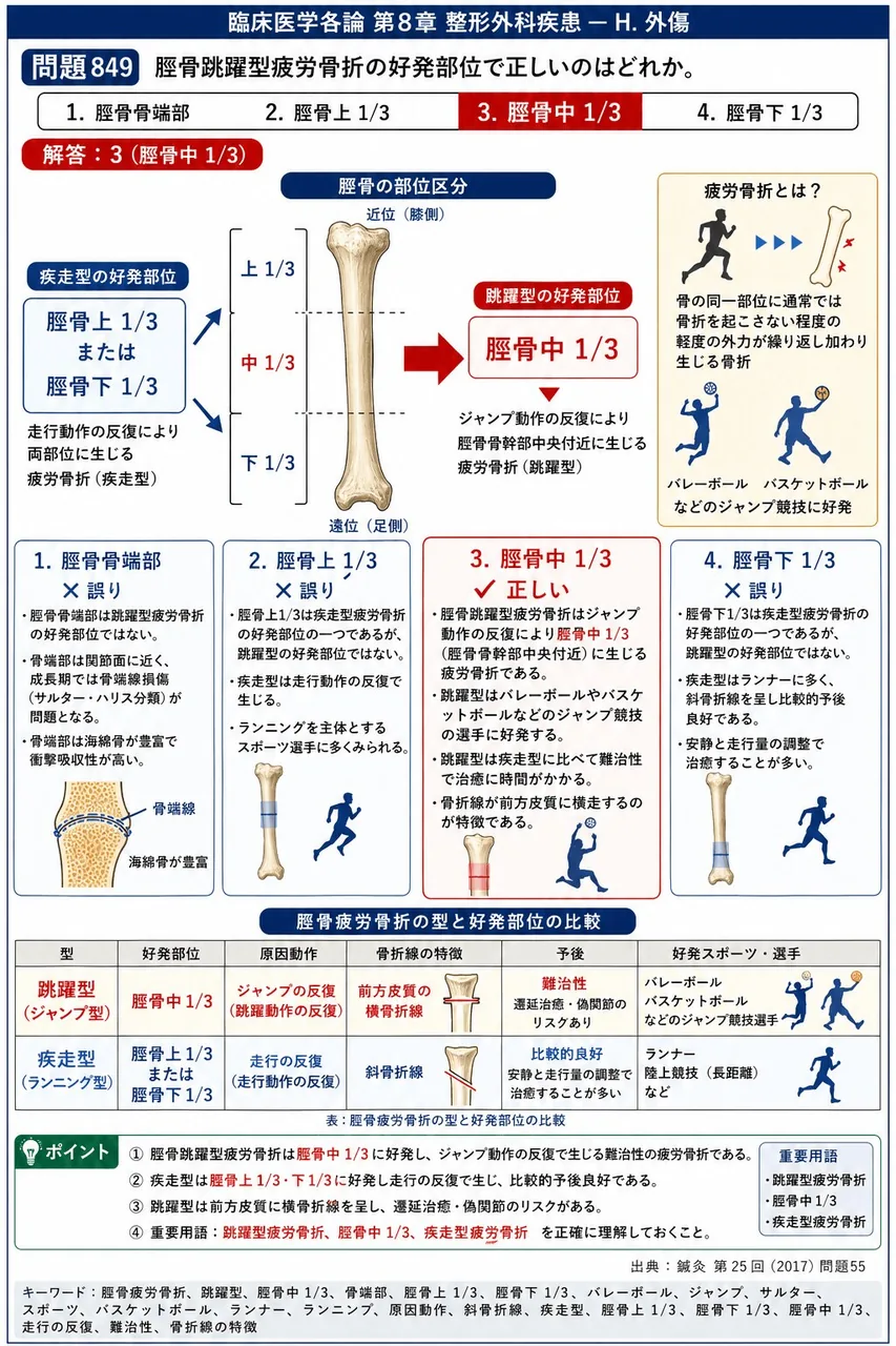 鍼灸 第25回(2017) 問題55｜脛骨跳躍型疲労骨折の好発部位で正しいのはどれか。 解説図