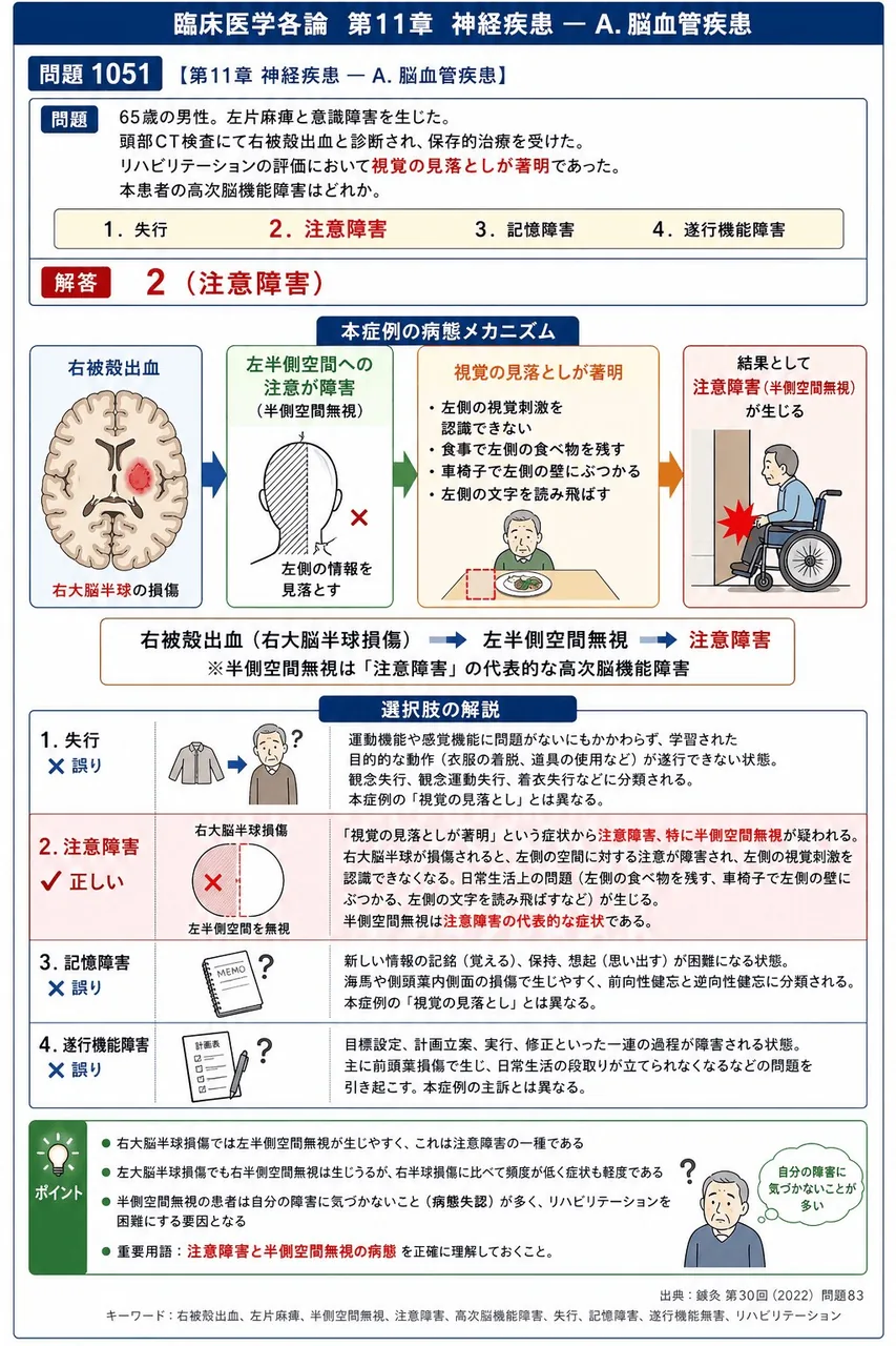 鍼灸 第30回(2022) 問題83｜「65歳の男性。左片麻痺と意識障害を生じた。頭部CT検査にて右被殻出血と診断され、保存的治療を受けた。リハビリテーションの評価において視覚の見落としが著明であった。」本患者の高次脳機能障害はどれか。 解説図