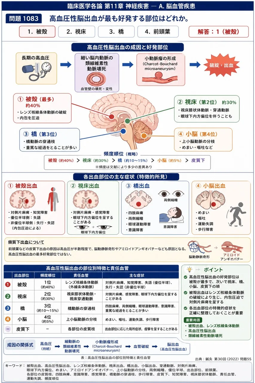 鍼灸 第30回(2022) 問題55｜高血圧性脳出血が最も好発する部位はどれか。 解説図