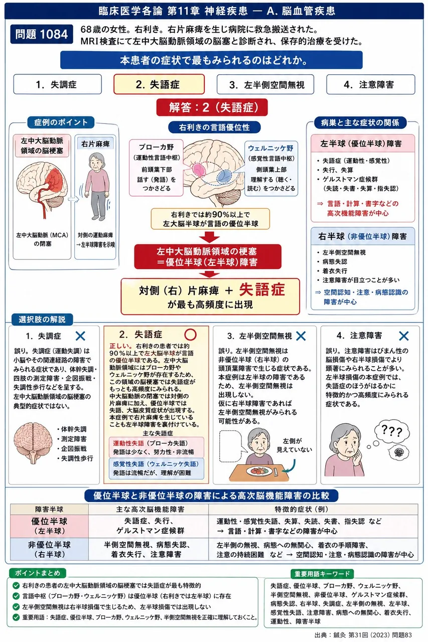 鍼灸 第31回(2023) 問題83｜「68歳の女性。右利き。右片麻痺を生じ病院に救急搬送された。MRI検査にて左中大脳動脈領域の脳塞と診断され、保存的治療を受けた。」本患者の症状で最もみられるのはどれか。 解説図