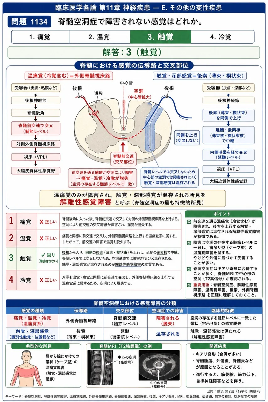 鍼灸 第2回(1994) 問題78｜脊髄空洞症で障害されない感覚はどれか。 解説図