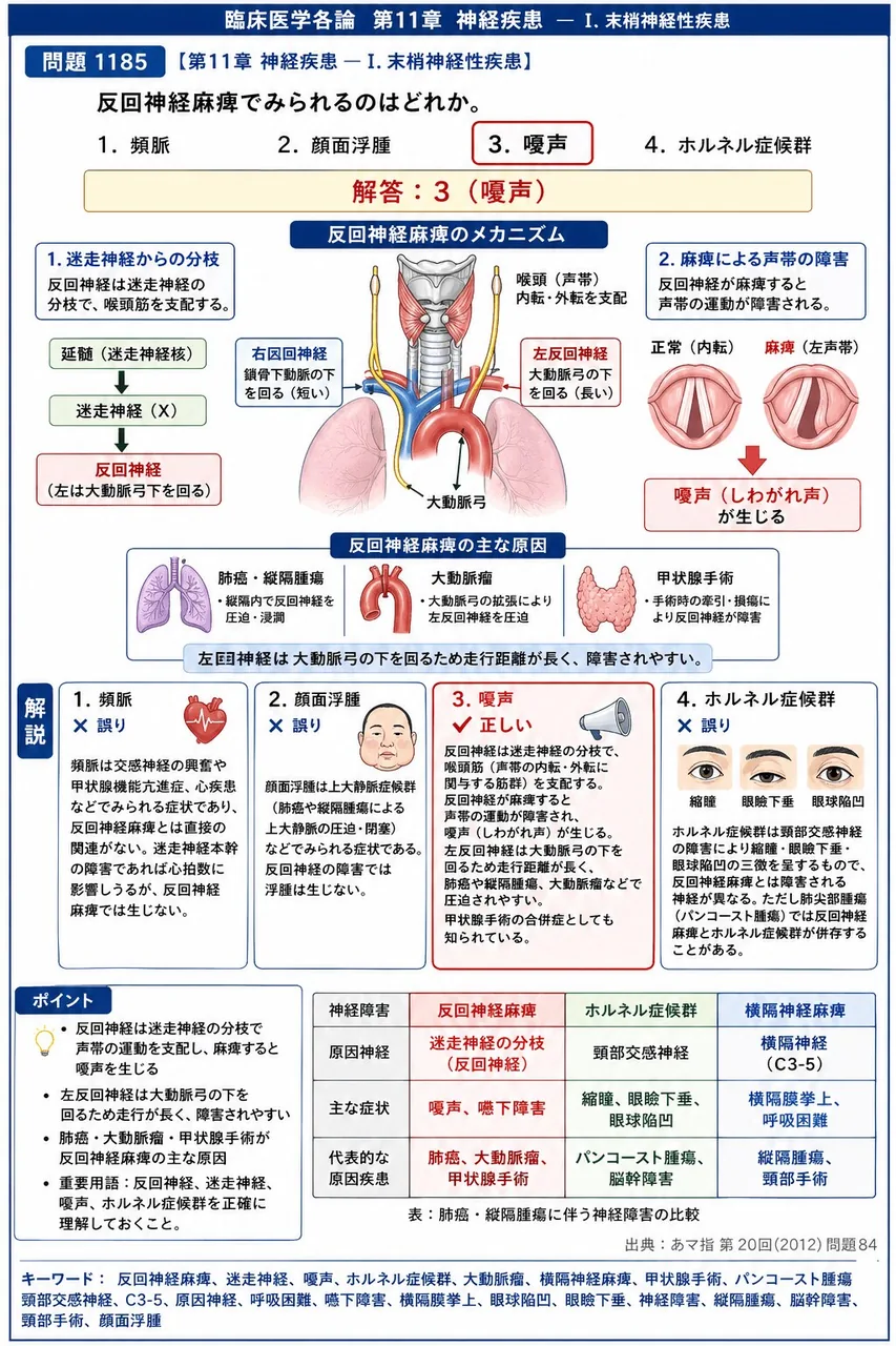 あマ指 第20回(2012) 問題84|反回神経麻痺でみられるのはどれか。 解説図