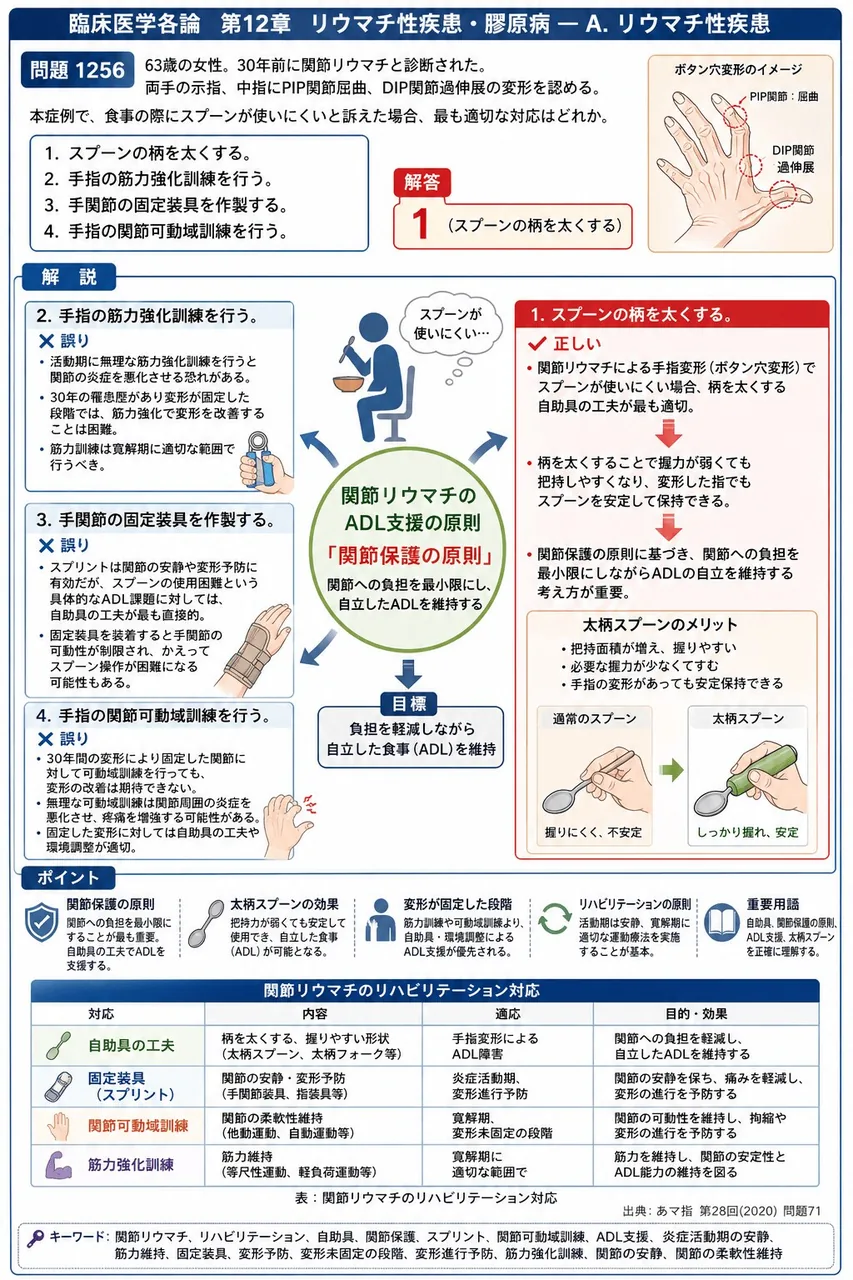 あマ指 第28回(2020) 問題71|「63歳の女性。30年前に関節リウマチと診断された。両手の示指、中指にPIP関節屈曲、DIP関節過伸展の変形を認める。」本症例で、食事の際にスプーンが使いにくいと訴えた場合、最も適切な対応はどれか。 解説図