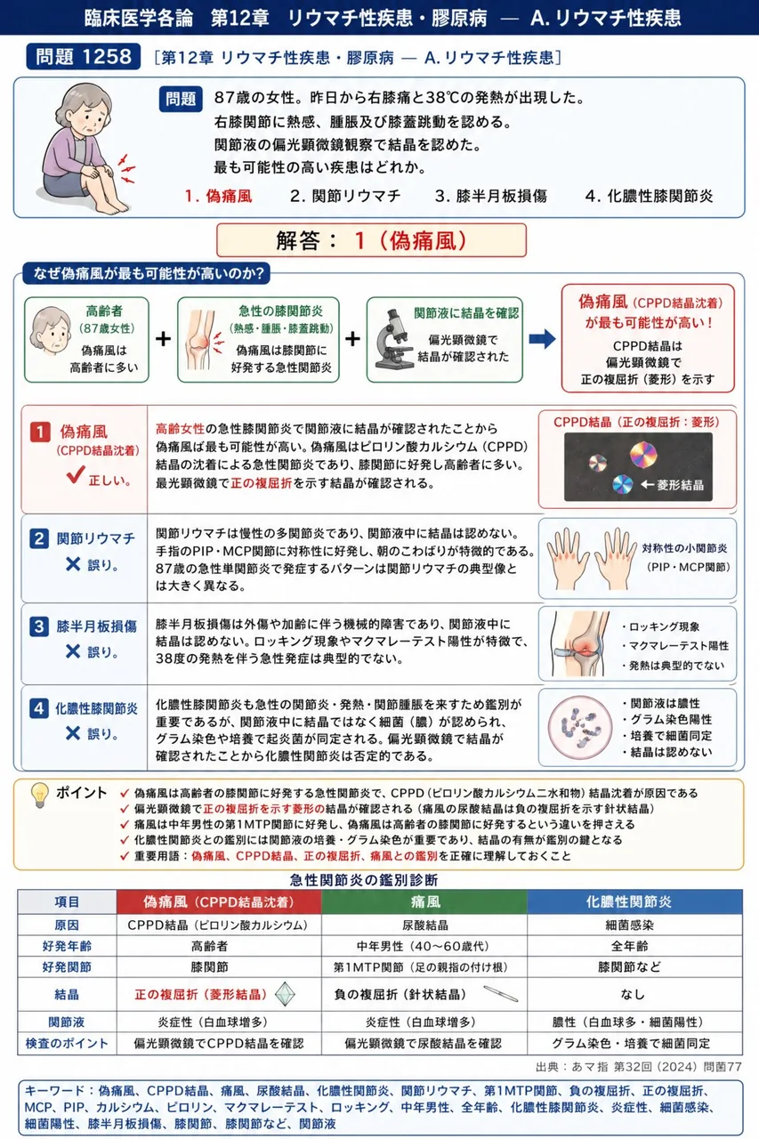 あマ指 第32回(2024) 問題77｜次の文で示す症例について、問いに答えよ。「87歳の女性。昨日から右膝痛と38℃の発熱が出現した。右膝関節に熱感、腫脹及び膝蓋跳動を認める。関節液の偏光顕微鏡観察で結晶を認めた。」最も可能性の高い疾患はどれか。 解説図